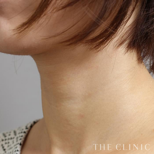 首のシワのマイクロCRF注入(顔の脂肪注入)（36歳女性）の術後写真