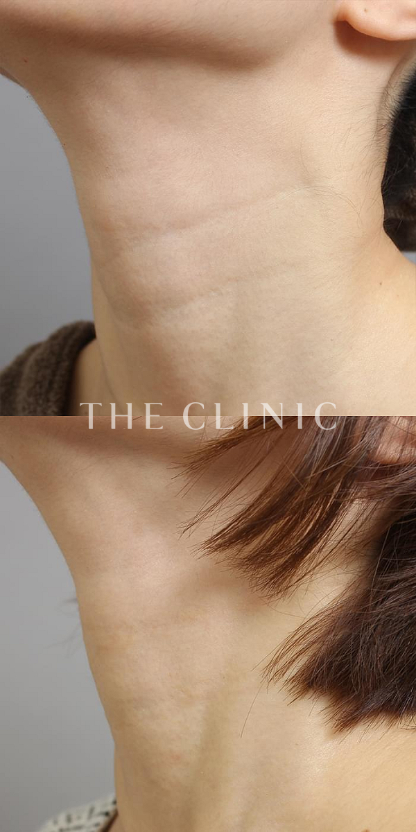 首のシワのマイクロCRF注入(顔の脂肪注入)（36歳女性）の術前・術後写真