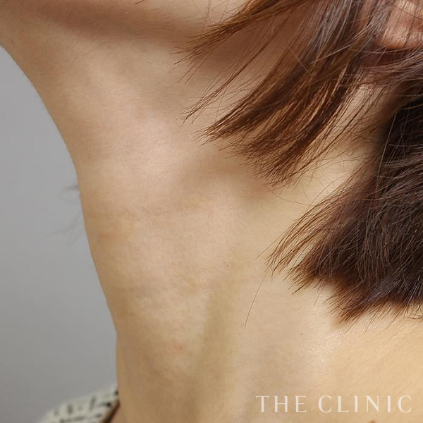 首のシワのマイクロCRF注入(顔の脂肪注入)（36歳女性）の術後写真