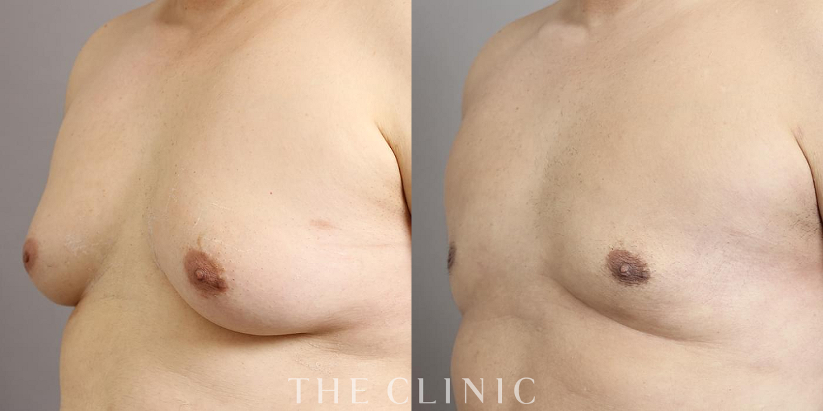 女性化乳房治療(男性の胸の膨らみ改善)の術前／術後