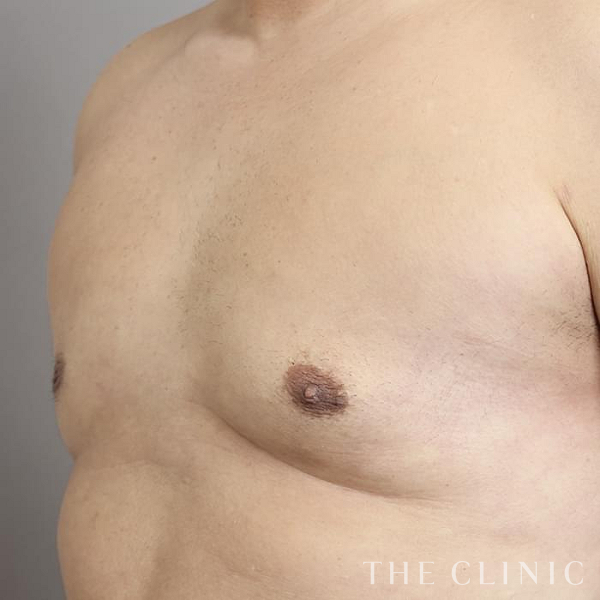 女性化乳房・偽性女性化乳房の女性化乳房治療(男性の胸の膨らみ改善)（41歳男性）の術後写真