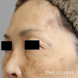 こめかみのコンデンスリッチフェイス(顔の脂肪注入)のモニター(50代)術前症例画像