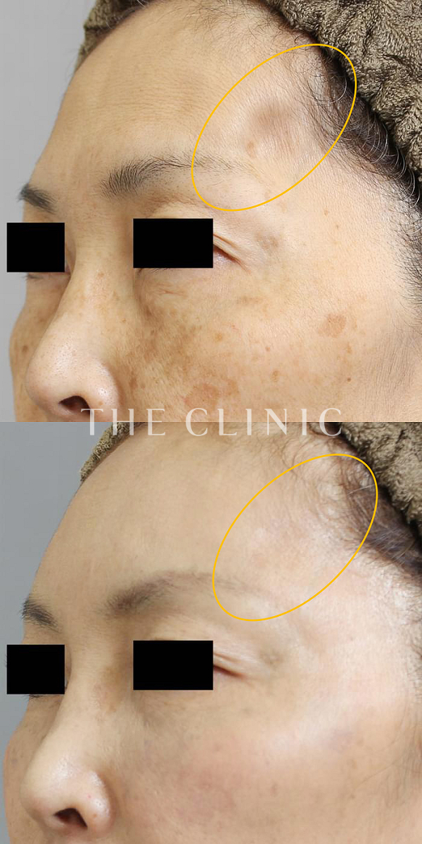 こめかみのコンデンスリッチフェイス(顔の脂肪注入)（52歳女性）の術前・術後写真