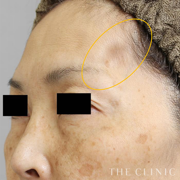 こめかみのコンデンスリッチフェイス(顔の脂肪注入)（52歳女性）の術前写真