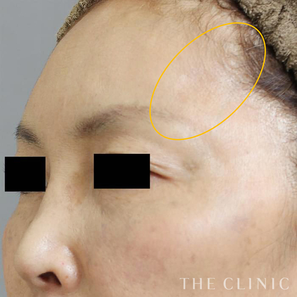 こめかみのコンデンスリッチフェイス(顔の脂肪注入)（52歳女性）の術後写真