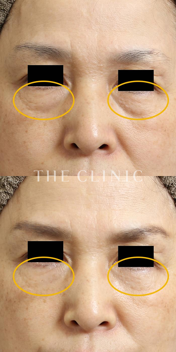 目の下のクマのマイクロCRF注入(顔の脂肪注入)（58歳女性）の術前・術後写真