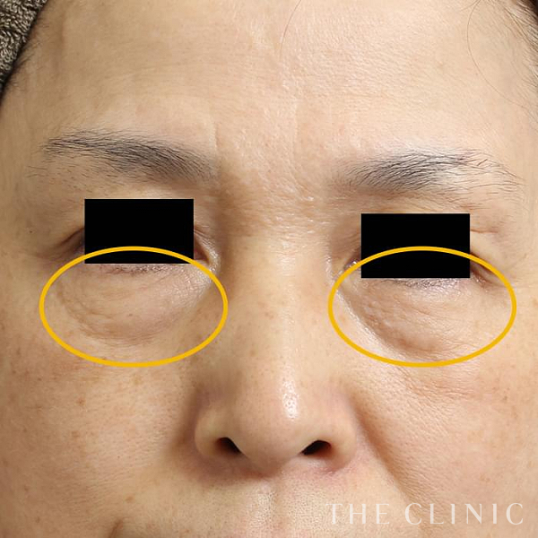 目の下のクマのマイクロCRF注入(顔の脂肪注入)（58歳女性）の術前写真