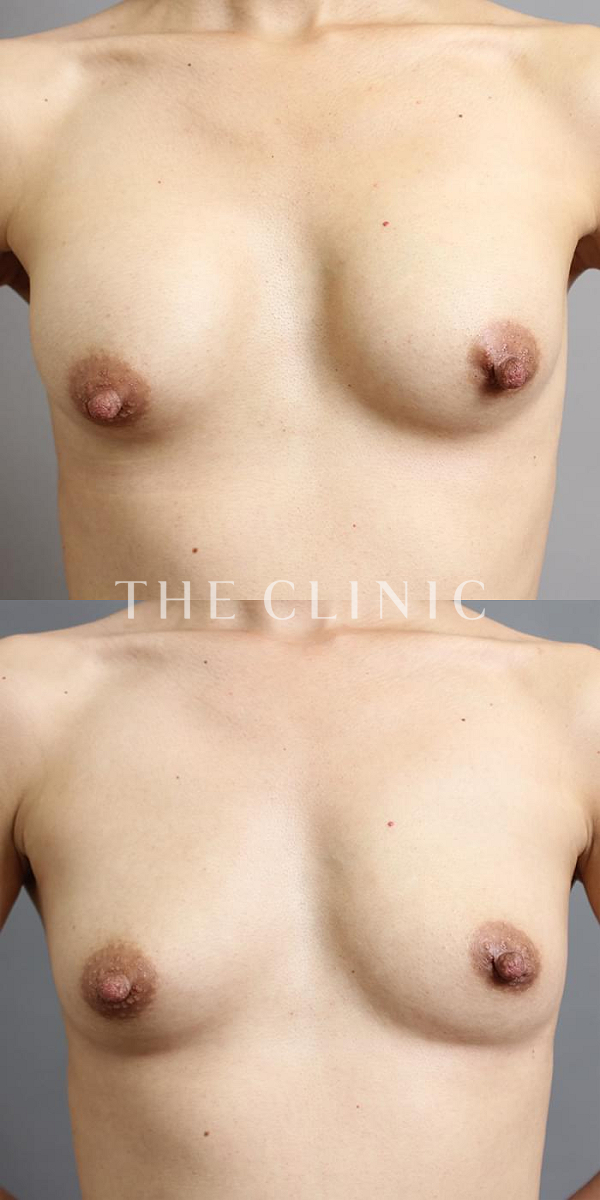 シリコンバッグ抜去の豊胸シリコンバッグ除去（38歳女性）の術前・術後写真