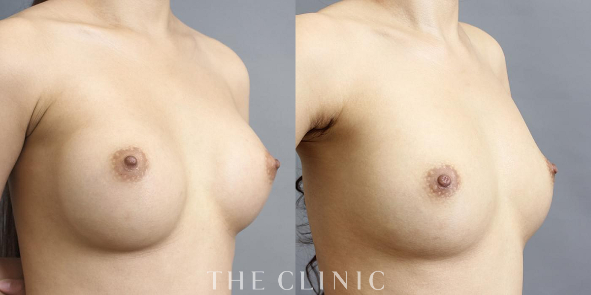 豊胸シリコンバッグ除去の術前／術後