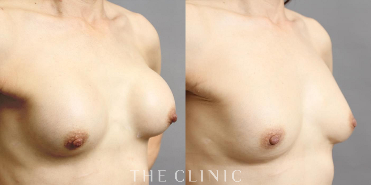 豊胸シリコンバッグ除去の術前／術後