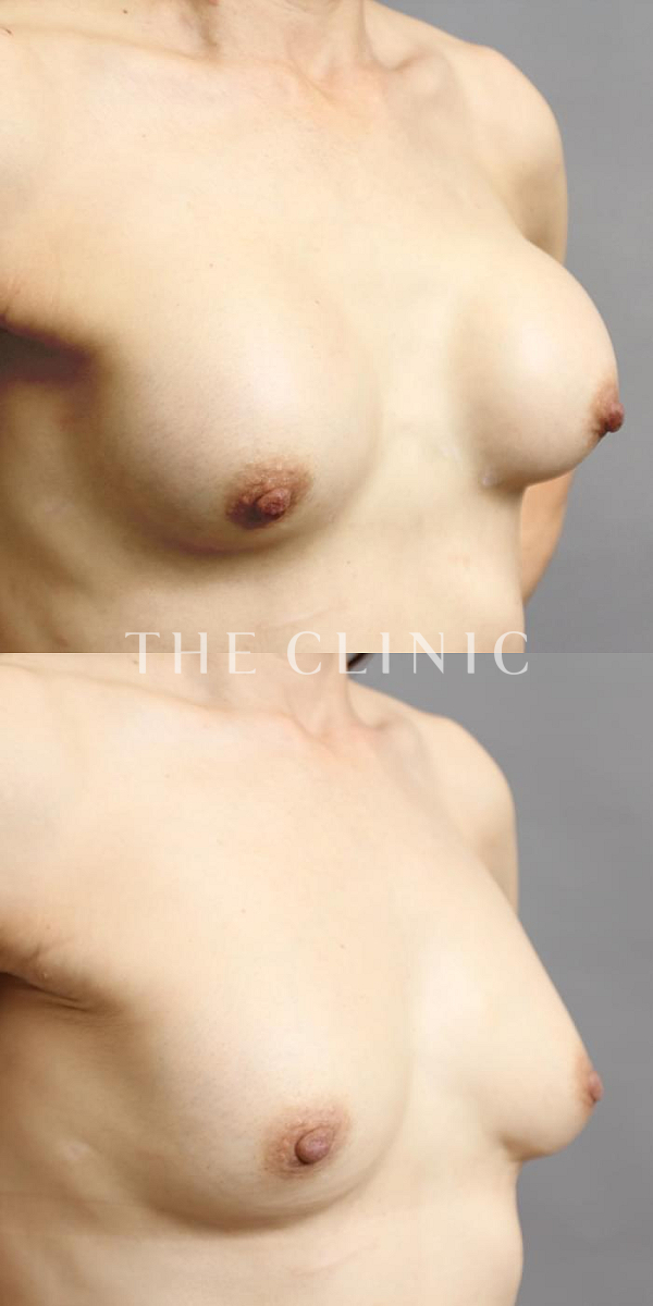 シリコンバッグ抜去・カプセル拘縮の豊胸シリコンバッグ除去（57歳女性）の術前・術後写真