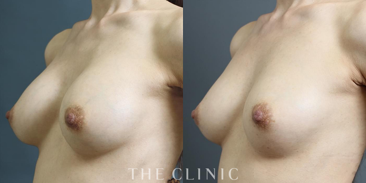 豊胸シリコンバッグ除去の術前／術後