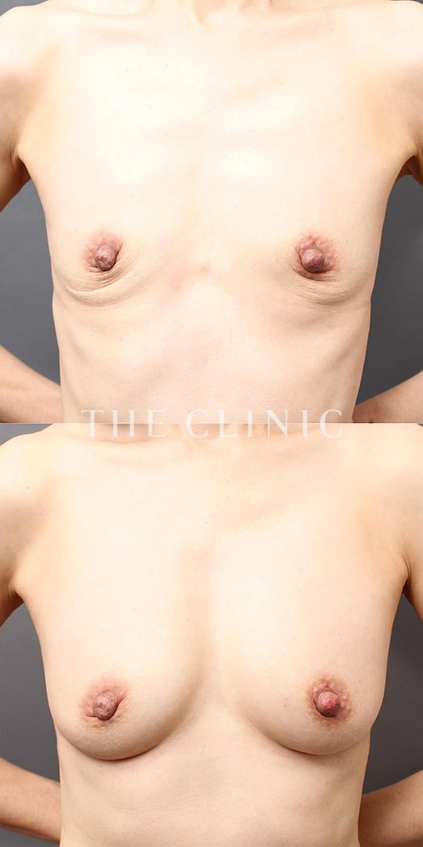 授乳後のたるみのコンデンスリッチ豊胸（45歳女性）の術前・術後写真
