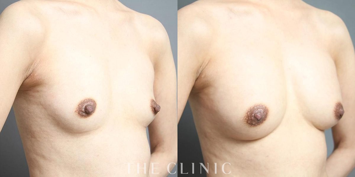 コンデンスリッチ豊胸の術前/術後