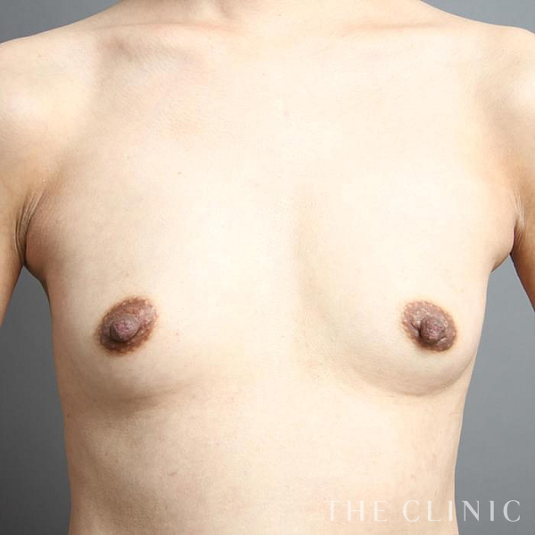 ボリュームアップのコンデンスリッチ豊胸（42歳女性）の術前写真