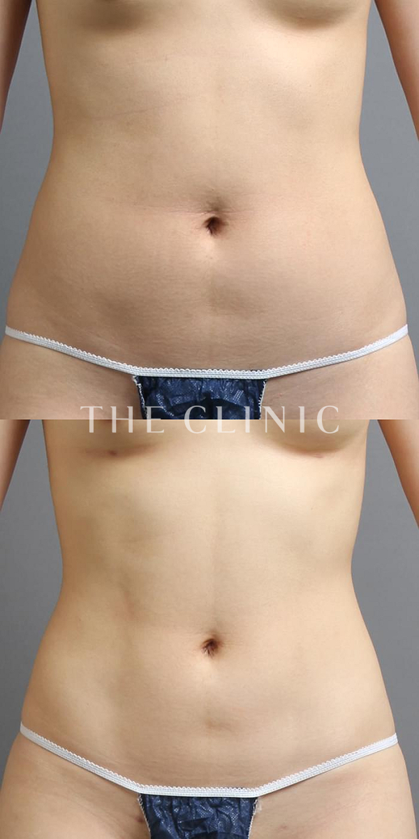 腹部・腰・ウエスト・TWOPACK 陰影ある腹部の4D脂肪吸引(4Dリポ)（27歳女性）の術前・術後写真
