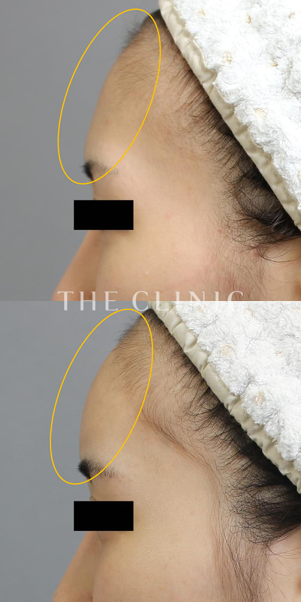 額のシワ・こめかみのコンデンスリッチフェイス(顔の脂肪注入)（23歳女性）の術前・術後写真