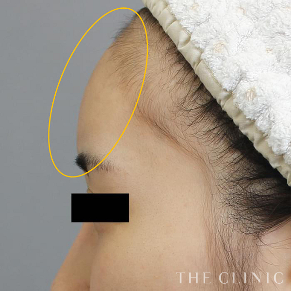 額のシワ・こめかみのコンデンスリッチフェイス(顔の脂肪注入)（23歳女性）の術後写真