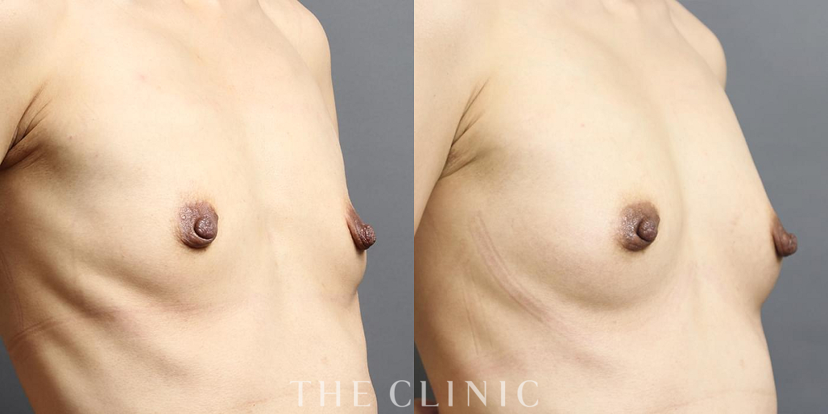 コンデンスリッチ豊胸の術前/術後