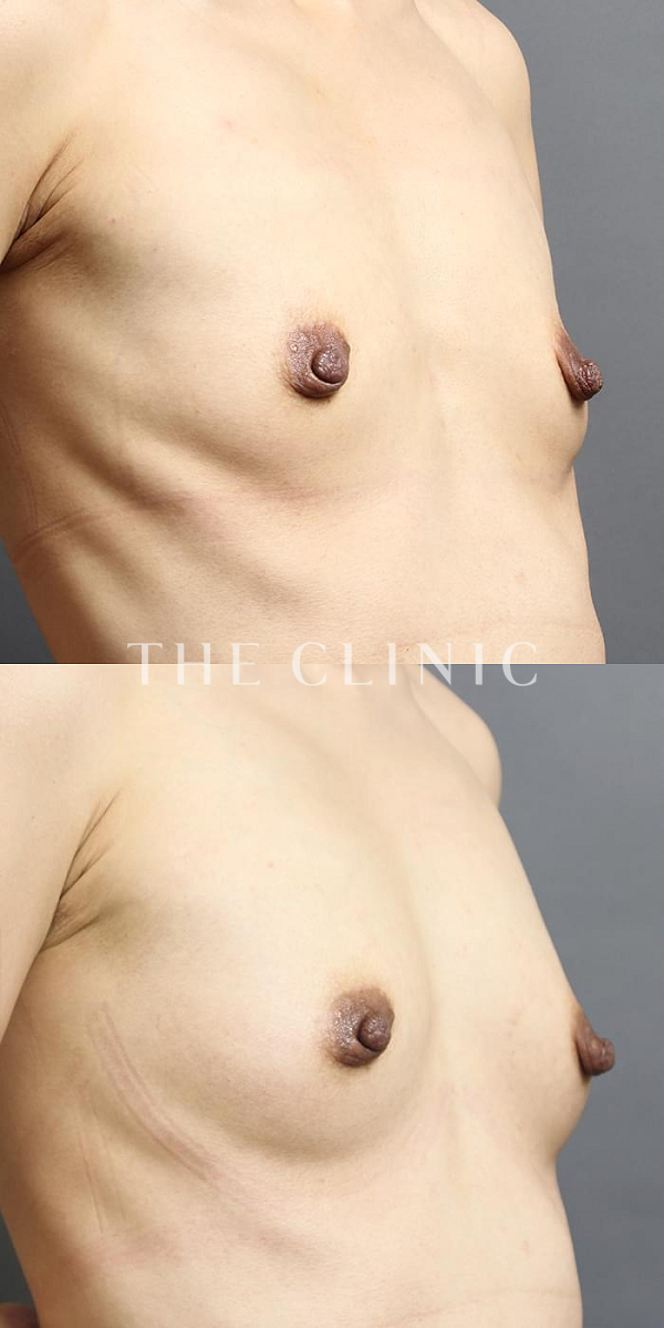 ボリュームアップのコンデンスリッチ豊胸（37歳女性）の術前・術後写真