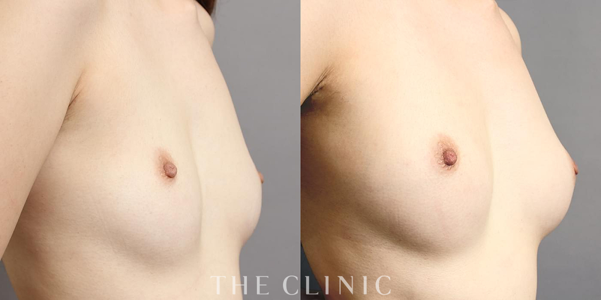 コンデンスリッチ豊胸の術前/術後