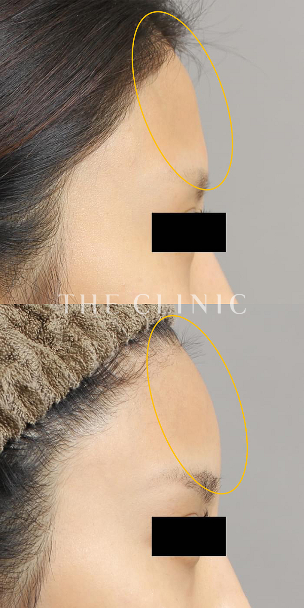 額のシワのコンデンスリッチフェイス(顔の脂肪注入)（26歳女性）の術前・術後写真