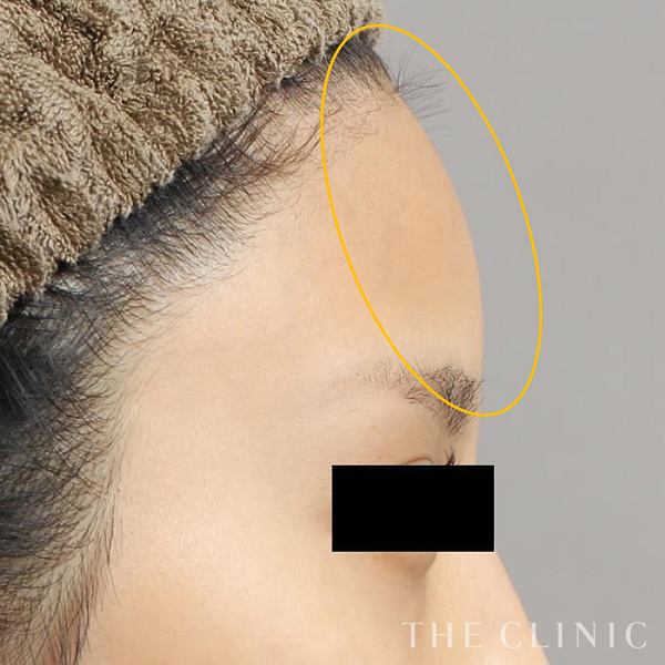 額のシワのコンデンスリッチフェイス(顔の脂肪注入)（26歳女性）の術後写真