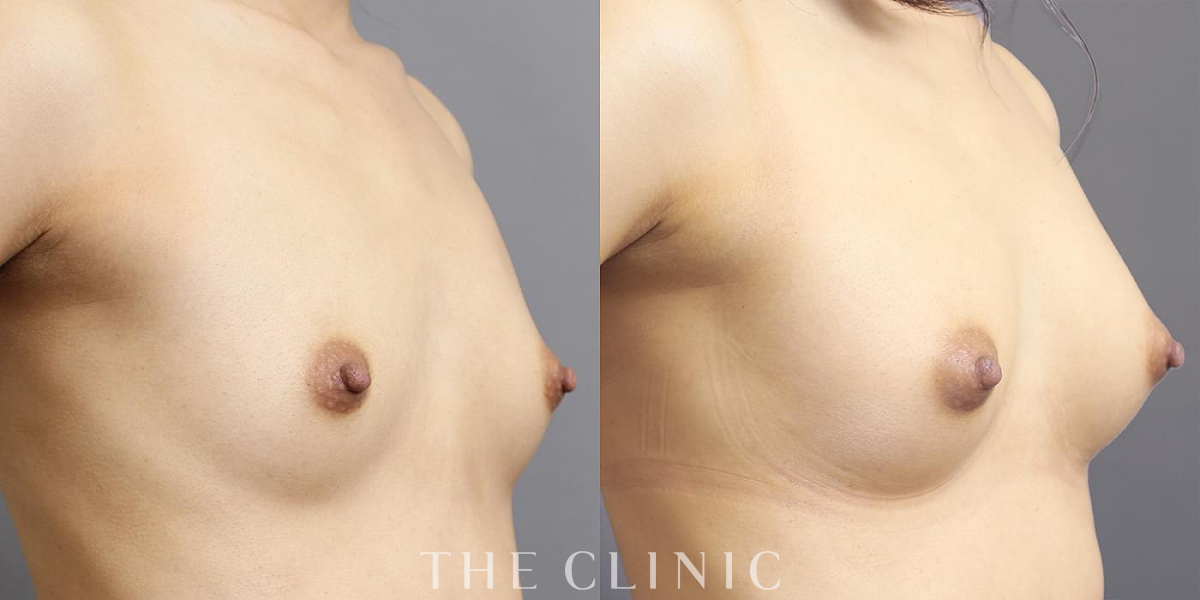 コンデンスリッチ豊胸の術前/術後