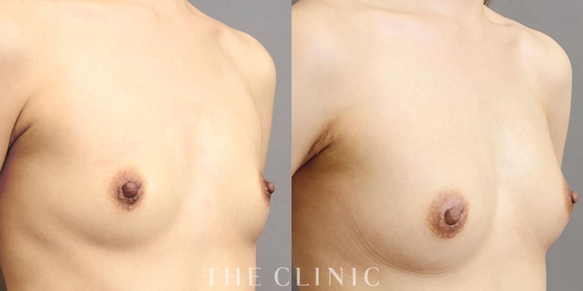 コンデンスリッチ豊胸の術前/術後