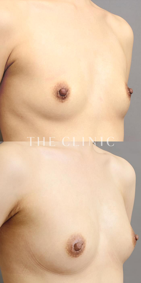 ボリュームアップのコンデンスリッチ豊胸（34歳女性）の術前・術後写真