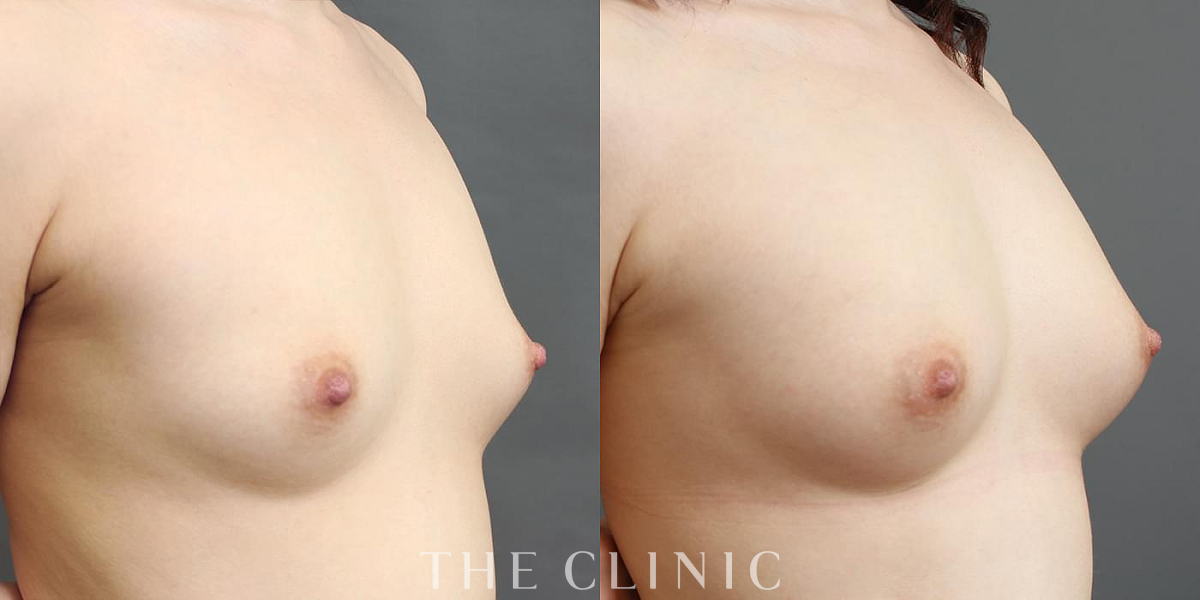 コンデンスリッチ豊胸の術前/術後