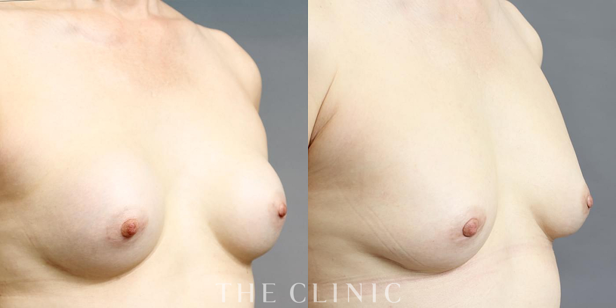 豊胸シリコンバッグ除去の術前／術後