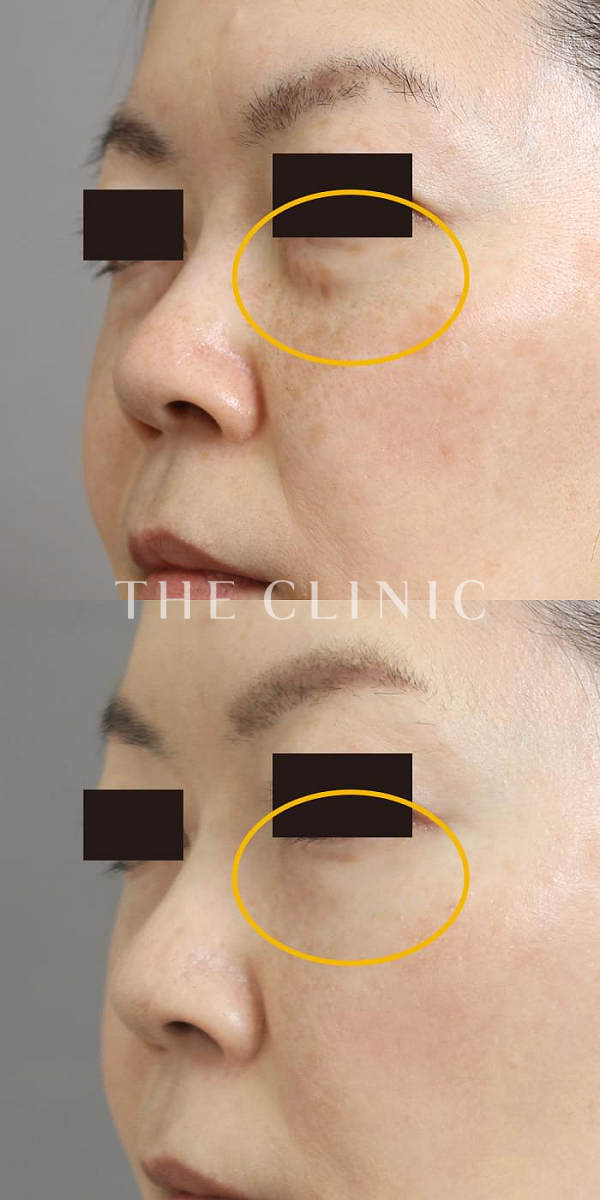 目の下のクマのマイクロCRF注入(顔の脂肪注入)（46歳女性）の術前・術後写真