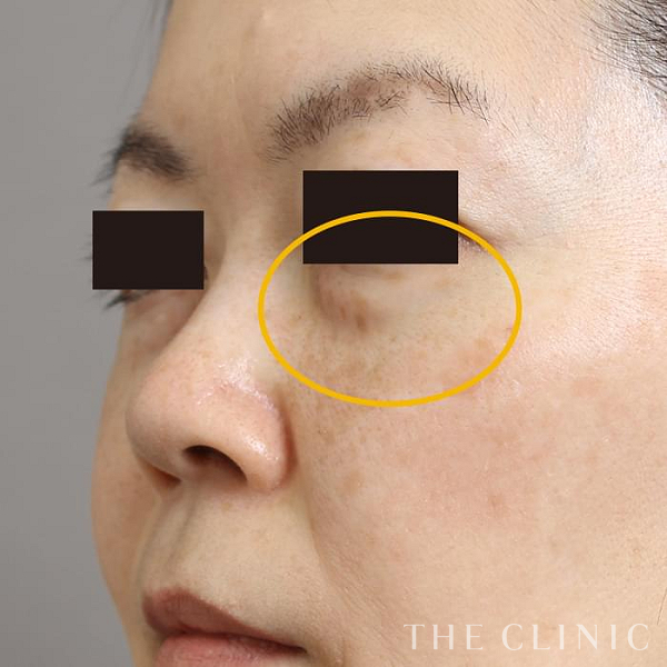 目の下のクマのマイクロCRF注入(顔の脂肪注入)（46歳女性）の術前写真