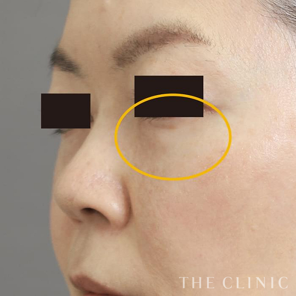 目の下のクマのマイクロCRF注入(顔の脂肪注入)（46歳女性）の術後写真