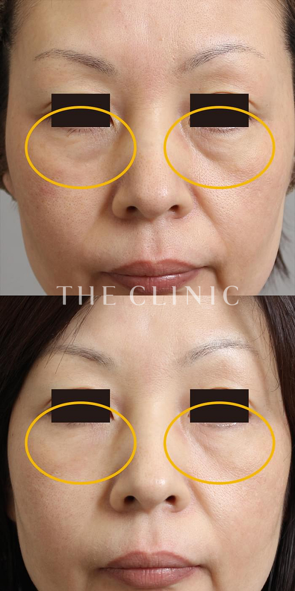 目の下のクマのマイクロCRF注入(顔の脂肪注入)（47歳女性）の術前・術後写真