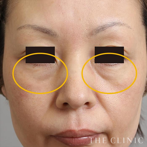 目の下のクマのマイクロCRF注入(顔の脂肪注入)（47歳女性）の術前写真