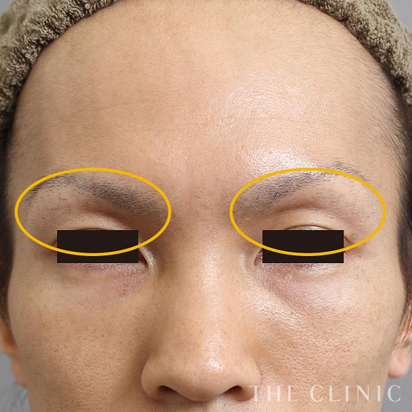 目の上のくぼみのマイクロCRF注入(顔の脂肪注入)（33歳男性）の術前写真