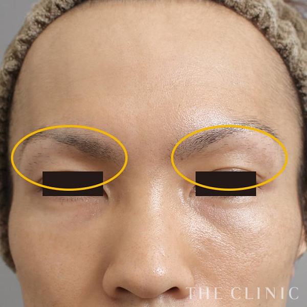 目の上のくぼみのマイクロCRF注入(顔の脂肪注入)（33歳男性）の術後写真