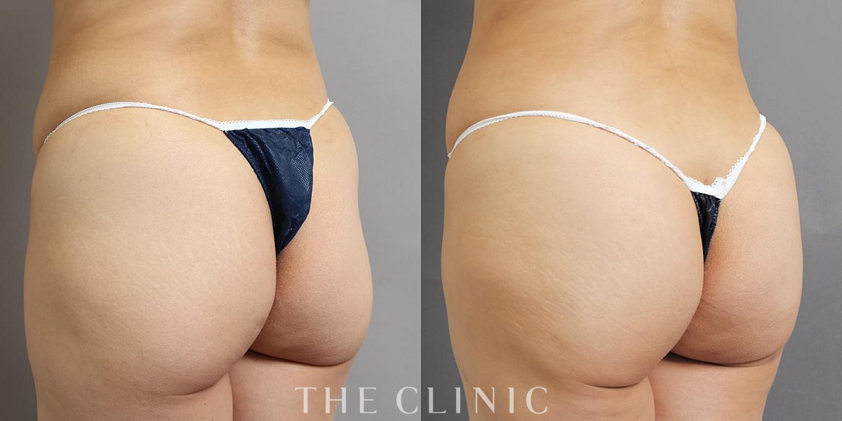 ヒップメイク by 360脂肪吸引®の術前／術後