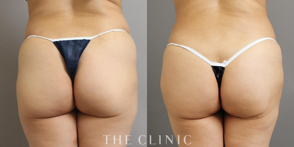 ヒップメイク by 360脂肪吸引®の術前／術後