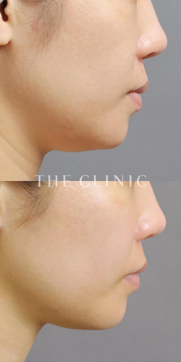 頰／顎のベイザー脂肪吸引（36歳女性）の術前・術後写真