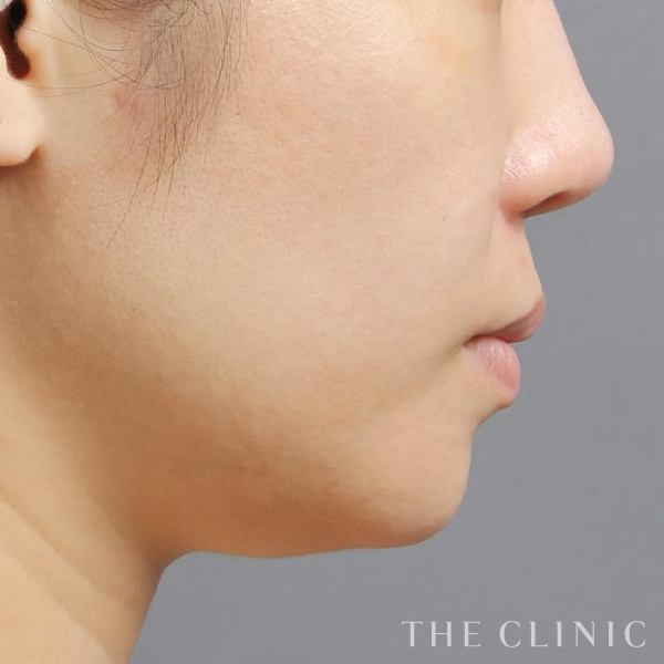 頰／顎のベイザー脂肪吸引（36歳女性）の術前写真