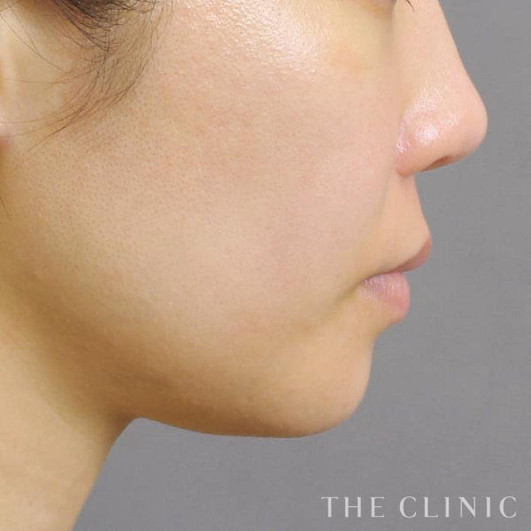 頰／顎のベイザー脂肪吸引（36歳女性）の術後写真
