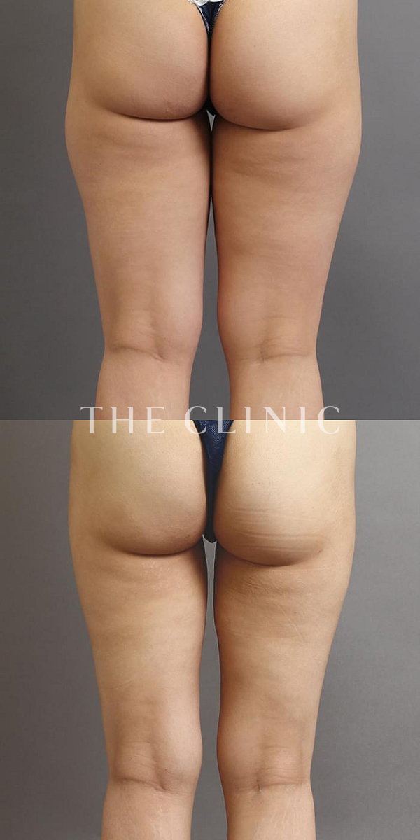 太もものベイザー脂肪吸引（23歳女性）の術前・術後写真