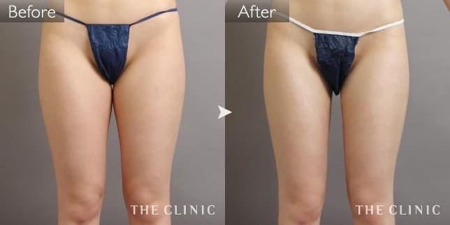 太もも（女性／24歳）