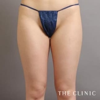 【THE CLINIC 症例画像】No.579_1_太もも_360脂肪吸引®(執刀医:村田 八千穂)