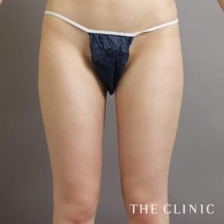 【THE CLINIC 症例画像】No.579_2_太もも_360脂肪吸引®(執刀医:村田 八千穂)
