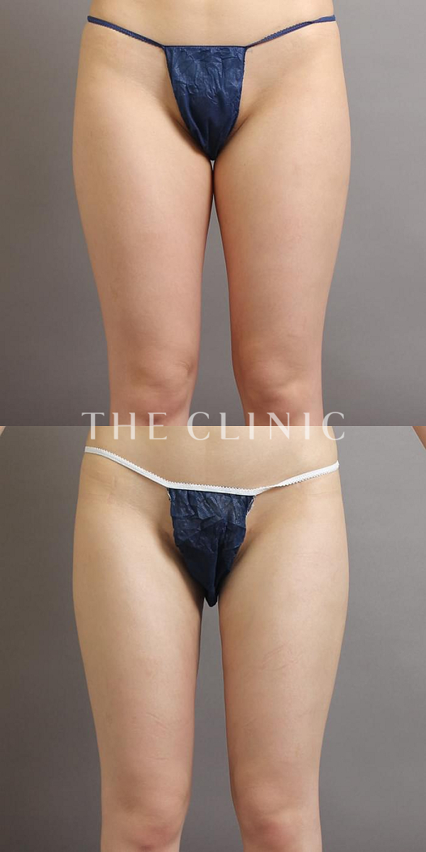 太もものベイザー脂肪吸引（24歳女性）の術前・術後写真