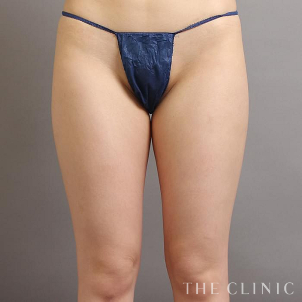 太もものベイザー脂肪吸引（24歳女性）の術前写真